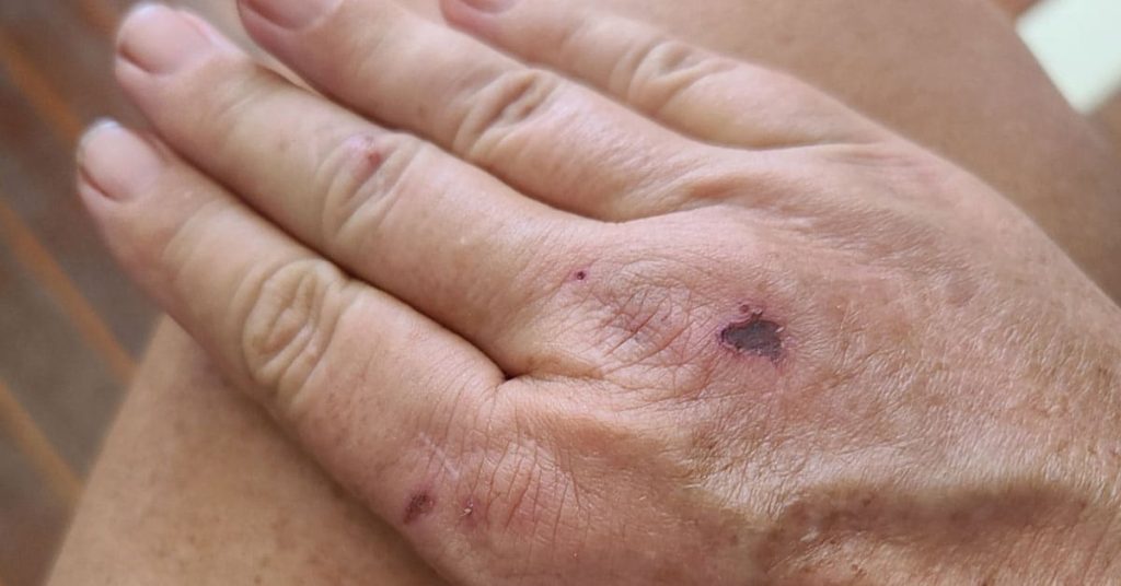 Navigating Minor Injuries in Boat Projects